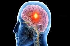 Epilepsi Gangguan Sistem...