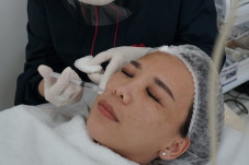 Treatment Mochi Scar...