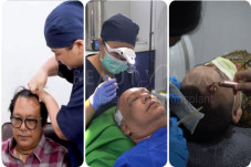 Transplantasi Rambut...