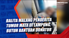 Balita Malang Penderita...