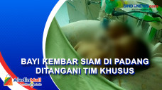 Bayi Kembar Siam di...