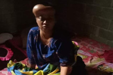 Diserang Tumor Otak,...