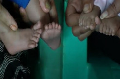 Unik, Bayi Kembar Ini Masing-masing Memiliki 12 Jari Kaki