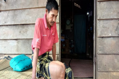 Memilukan, Petani Kopi Ini Lumpuh Setelah Kakinya Diserang Tumor Ganas