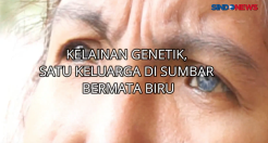 Kelainan Genetik, Satu Keluarga di Sumbar Bermata Biru
