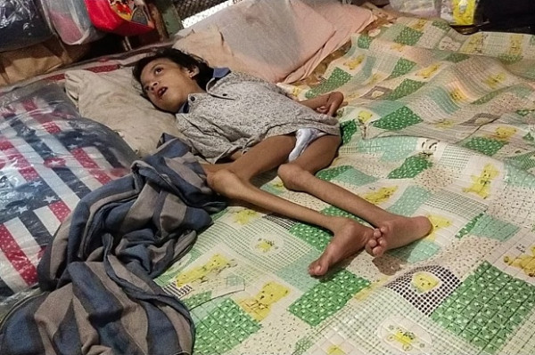 Dalam Kemiskinan, 17 Tahun Kakek Ini Merawat Cucunya yang Lumpuh