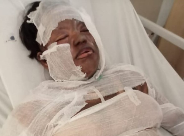 Diduga Selingkuh dengan Pria Idaman Lain, Wanita di Deli Serdang Dibakar Suami