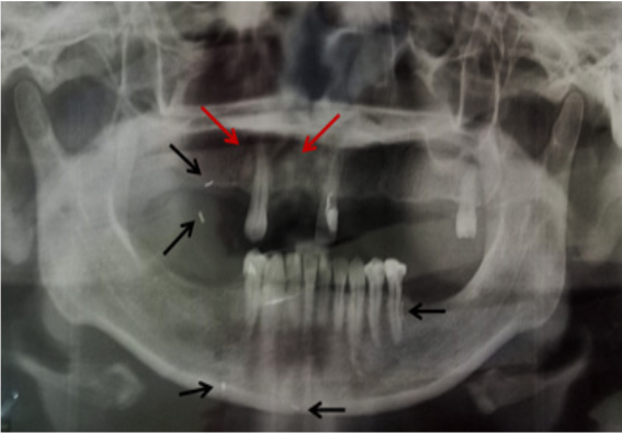 Viral Temuan Susuk pada Pemeriksaan Radiologi, Ini Penjelasan Medisnya