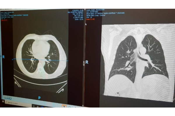 Saleh Husin: Alhamdulillah Hasil CT Scan Paru-paru Saya Bersih
