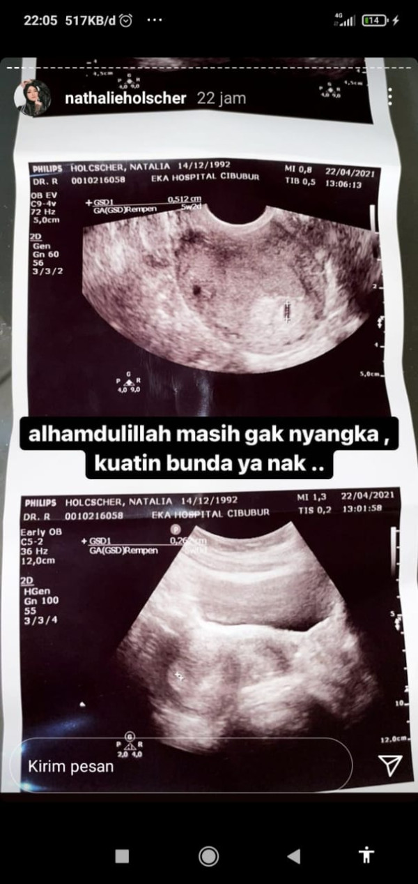 Unggah Foto Hasil USG, Nathalie Holscher Masih Nggak Menyangka Dirinya Hamil