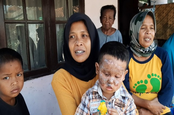 Miris, Main Petasan dengan Kakaknya Balita 3,5 Tahun Wajahnya Hangus Terbakar