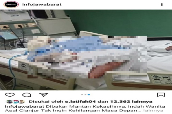Unggahan Foto Gadis Cantik yang Dibakar Pacarnya Sendiri Gemparkan Cianjur