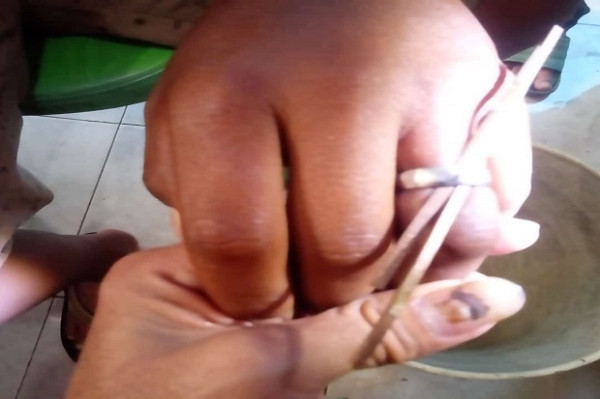 Tak Bisa Lepas Cincin di Jari Manis, Deni Mengadu ke Petugas Damkar Kuningan