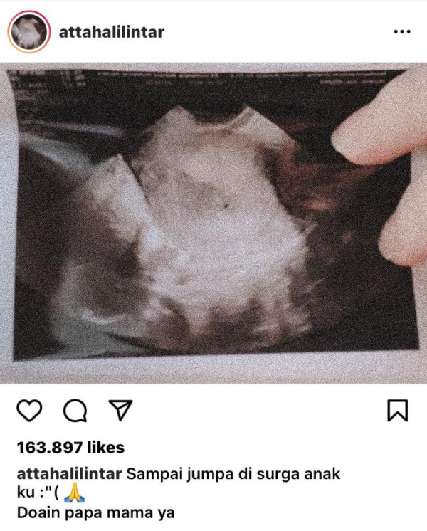 Sempat Alami Pendarahan, Aurel Hermansyah Keguguran