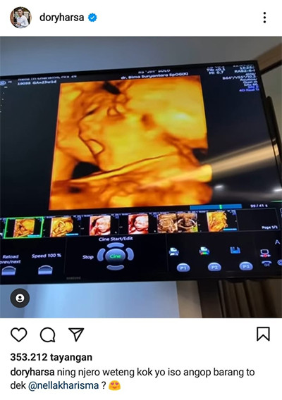 Bayi dalam Kandungan Nella Kharisma Menguap, Dory Harsa: Kok Ya Bisa?
