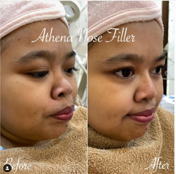 Kekeyi Filler Hidung, Netizen :