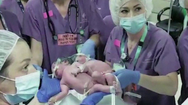 Bayi Kembar Siam di Kepala Sukses Operasi Pemisahan Langka di Israel
