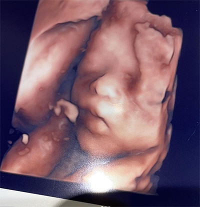 Nathalie Holscher Unggah Foto USG sang Bayi, Bibirnya Jadi Sorotan