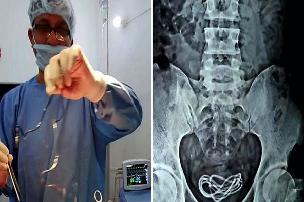 Dokter di India Keluarkan...