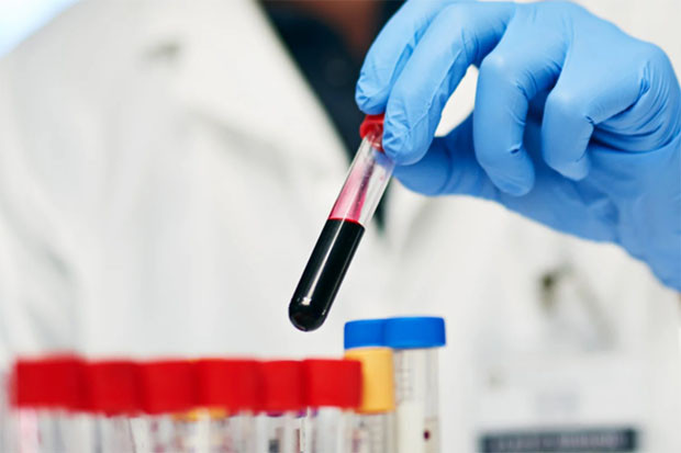 Hasil Test D-Dimer Bisa...