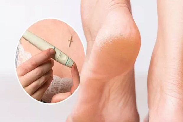 Kapalan di Kaki Indikasikan...