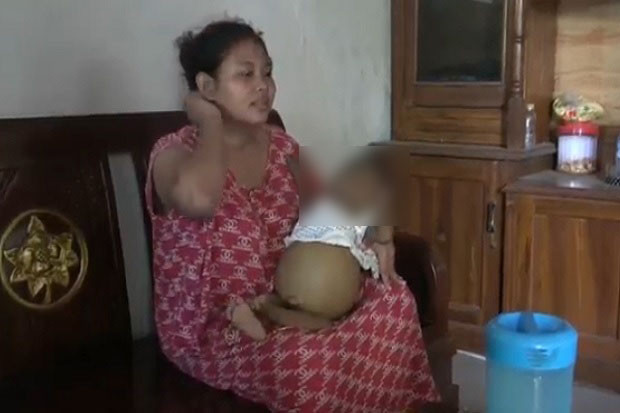 Miris, Bayi Perut Membesar...