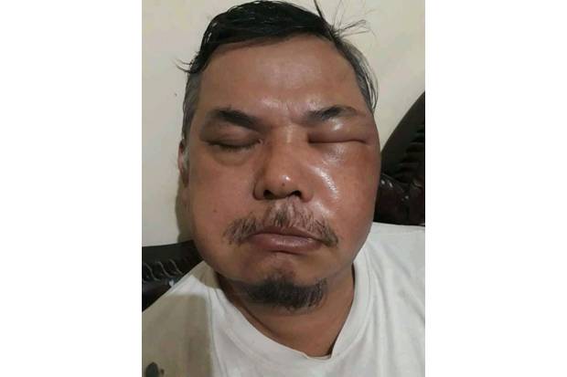Viral Wajah Pria Bengkak...