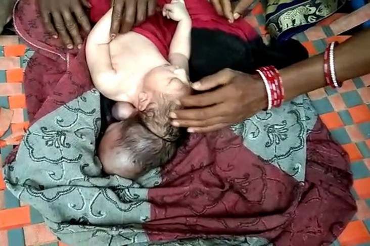 Bayi Berkepala Tiga...