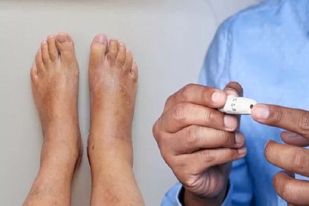 Tanda Diabetes di Kaki,...
