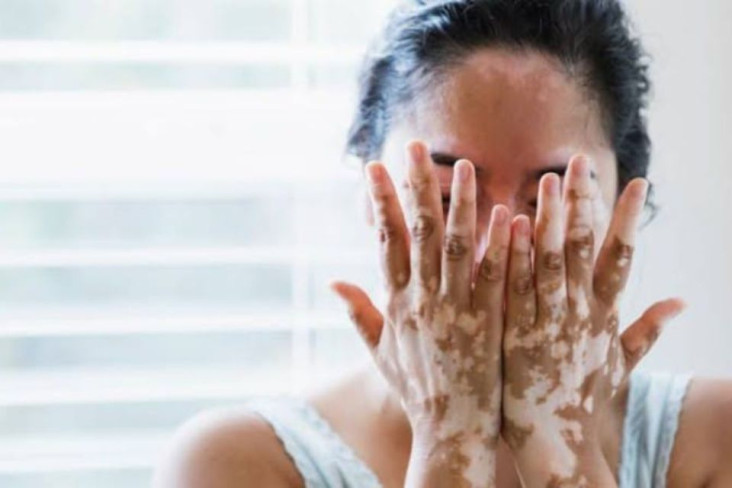Peringati Bulan Vitiligo,...