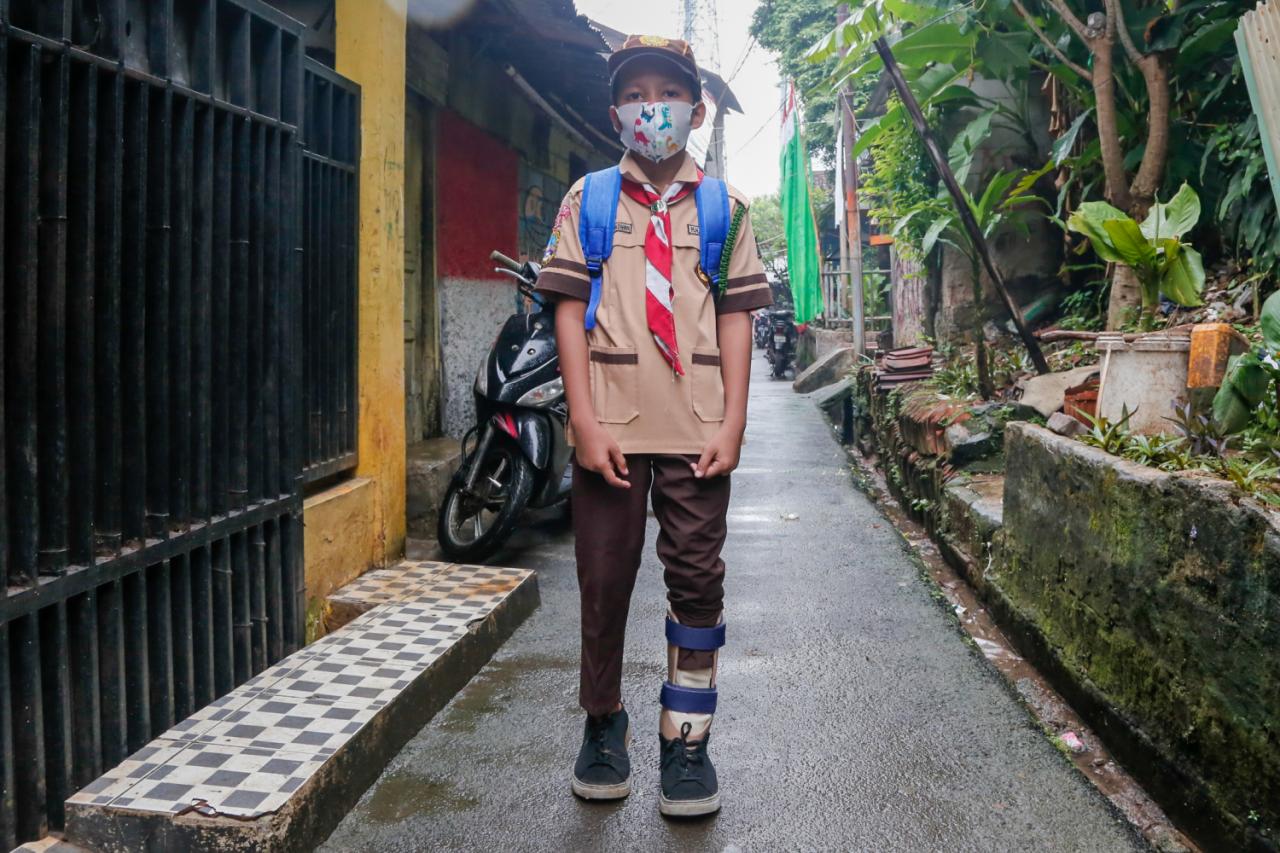 Alami Kelainan Kaki...