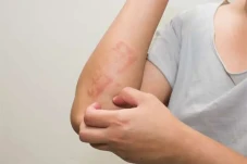Mengenal Psoriasis Plak...