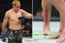 Kaki Tony Ferguson Terluka...
