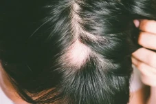Mengenal Penyebab Alopecia...