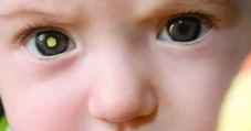 Apa Itu Retinoblastoma?...