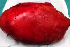 OMG, Tumor Seberat 5...