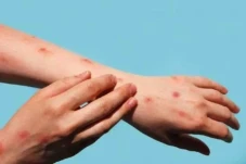 Virus Cacar Monyet Masuk...