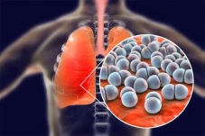 Waspada Kasus Pneumonia...