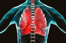 Epidemiolog Sebut Pneumonia...
