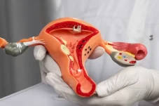 Kanker Serviks di Indonesia...