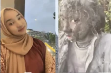 Luka Bakar 40 Persen,...