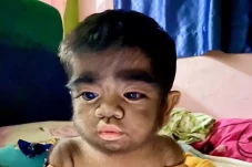 Anak Ini Idap Sindrom...