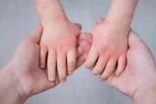 Pentingnya Tangani Alergi...