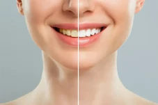 Proses dan Efek Bleaching...