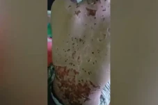 Ngeri! Siswi SMP Melepuh...