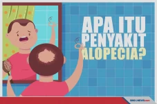 Mengenal Alopecia, Penyakit...