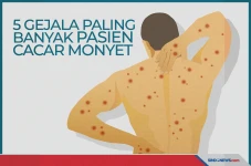 Ini 5 Gejala Cacar Monyet...
