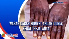 Wabah Cacar Monyet Ancam...