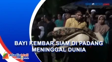 Bayi Kembar Siam di...