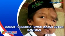 Menderita Tumor Wajah,...